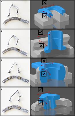 Different coupling mechanisms for a novel modular plate in acetabular fractures—a comparison using a laparoscopic model